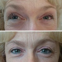 /album/fotogalerie/linky-pred-a-po-jpg/